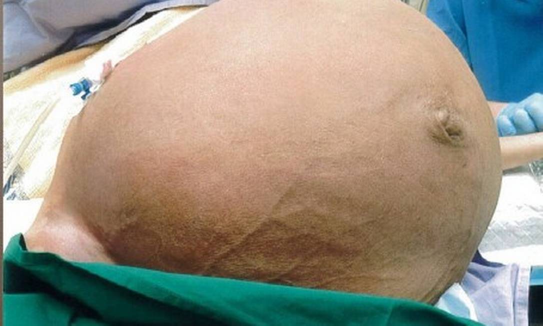 Mioma uterino de 64 centímetros e 28 kg é removido de paciente em