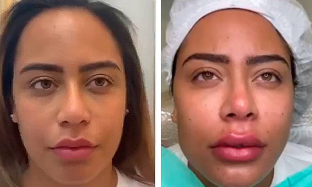 Confira O Antes E Depois De Famosos Que Fizeram Harmoniza O Facial Jornal O Globo