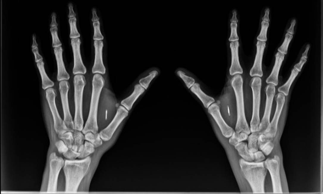 Thiago Bordini tem dois biochips implantados, um em cada mão Foto: Divulgação