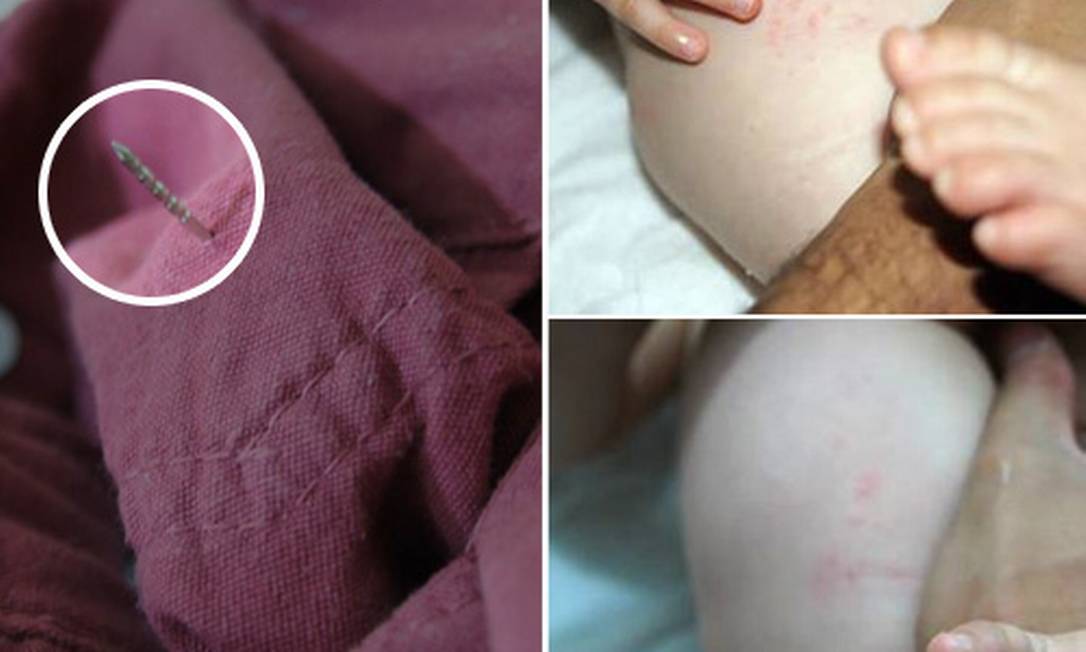 
Pino de metal causou escoriações em bebê de sete meses
Foto: FOTO: Arquivo pessoal