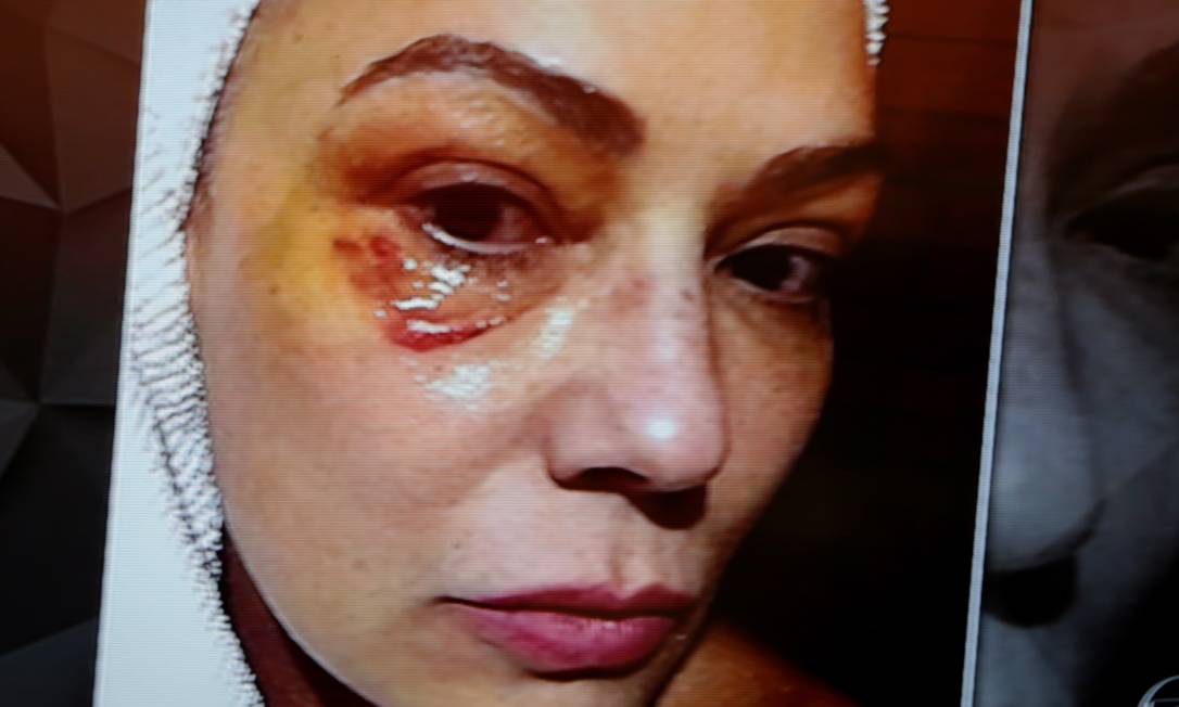 Luiza Brunet mostra olho machucado após alegar ter sofrido agressão de ex-companheiro Foto: Reprodução