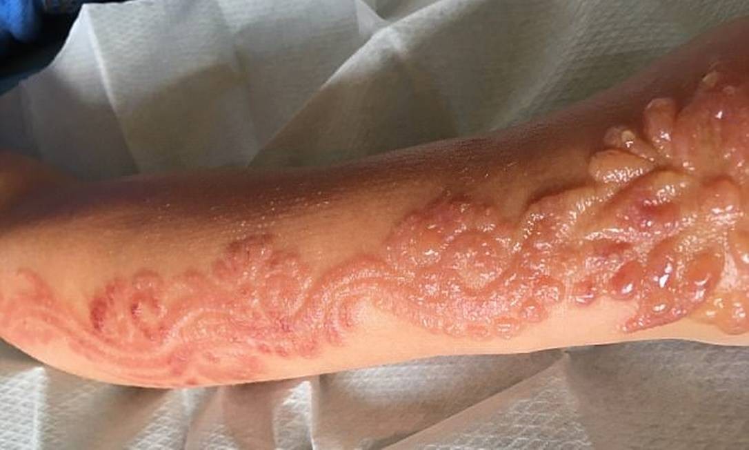 Tatuagem de henna gera cicatrizes permanentes em menina de