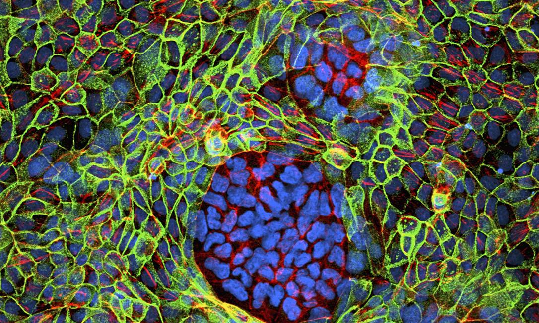 
Imagem microscópicas de dois grupos de células cancerosas cercados de células normais: desvendar metabolismo de tumores é próximo passo na luta contra doença
Foto:
/
Latinstock
