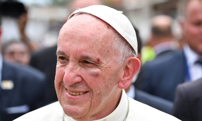 https://ogimg.infoglobo.com.br/in/21805719-d2e-e1f/FT1086A/420/x71557259_Pope-Francis-shows-a-bruise-around-his-left-eye-and-eyebrow-caused-by-an-accidental-hit.jpg.pagespeed.ic.VS71sAZO5c.jpg