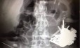 
Exame de raio-X revelou um “bezoar” de peças de metal na saída do estômago do paciente
