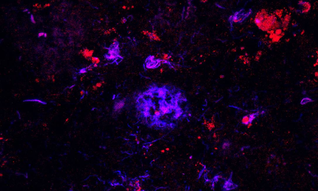 
Anticorpos da proteína APOE (em vermelho) se unem às placas de amiloide-beta (em azul) no tecido cerebral de pessoas com Alzheimer, marcando-as para sua remoção pelo sistema imunológico
Foto:
/
Monica Xiong
