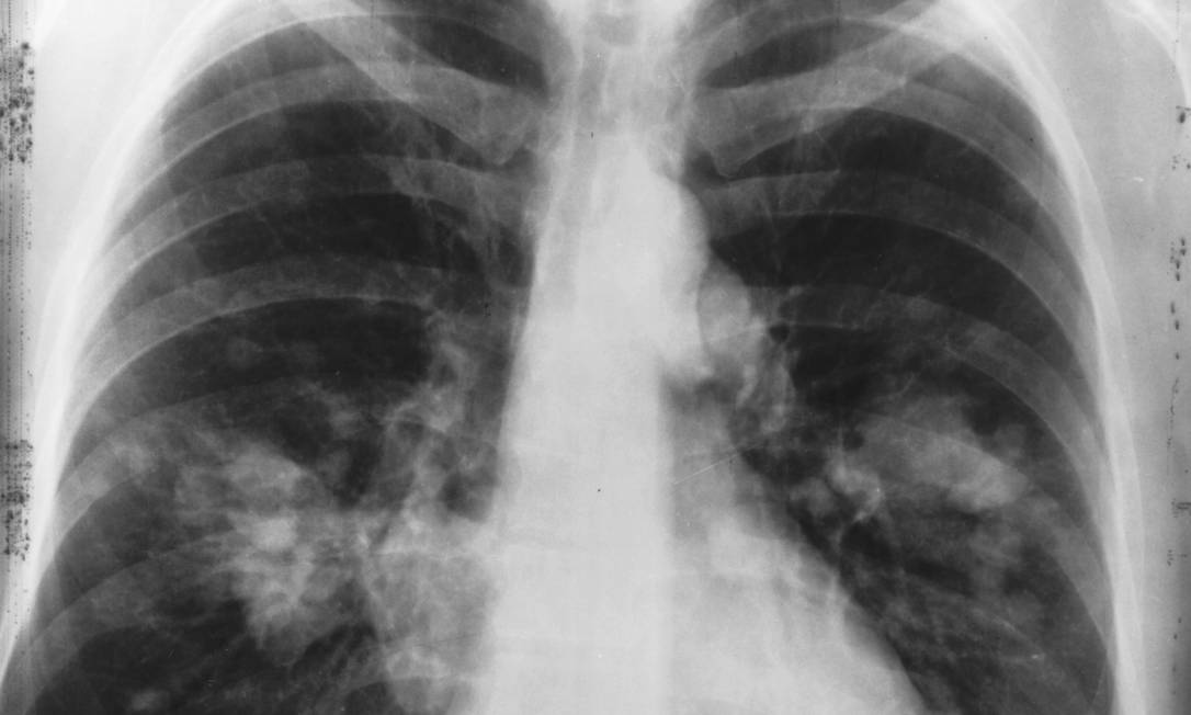 
Exame de raio-X de um pulmão com câncer: imunoterapia é nova alternativa de tratamento para a doença, uma das mais comuns do tipo
Foto:
/
Divulgação/Instituto Nacional do Câncer dos EUA
