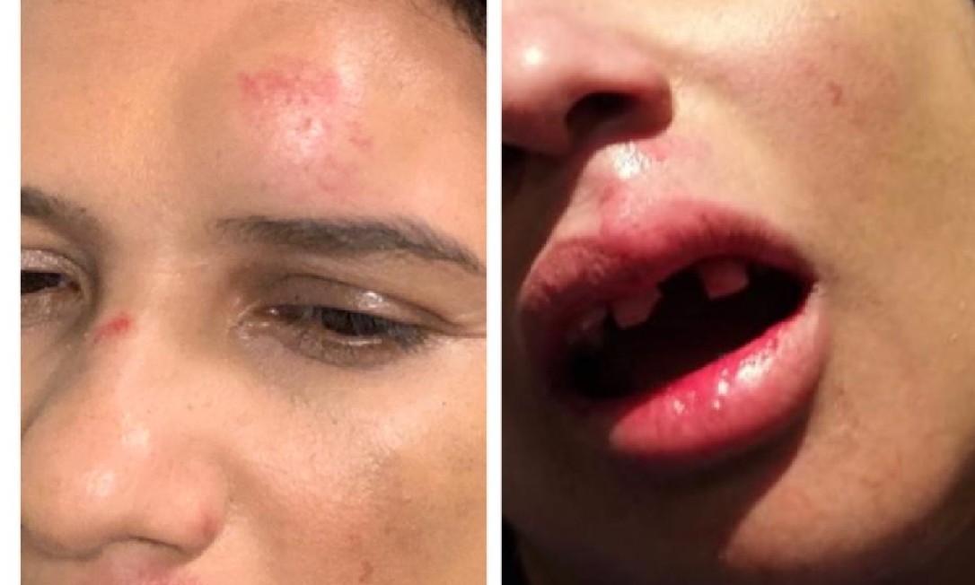 A deputada estadual Rosane Felix (PSD) participava da Marcha Pela Vida, em Copacabana, neste domingo e se acidentou utilizando um patinete Foto: Divulgação