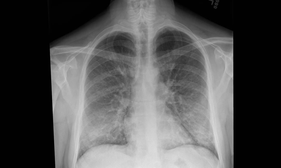 In an undated image provided by Intermountain Healthcare, an X-ray of a patient with a vaping habit, showing lung damage — densities or whitish cloud-like areas typically associated with some pneumonias, fluid in the lungs or inflammation. A surge of severe lung ailments among vapers has baffled doctors and public health experts. (Intermountain Healthcare via The New York Times) -- NO SALES; FOR EDITORIAL USE ONLY WITH VAPING-ILLNESS BY KAPLAN AND RICHTEL FOR AUG. 31, 2019. ALL OTHER USE PROHIBITED. -- Foto: INTERMOUNTAIN HEALTHCARE / NYT