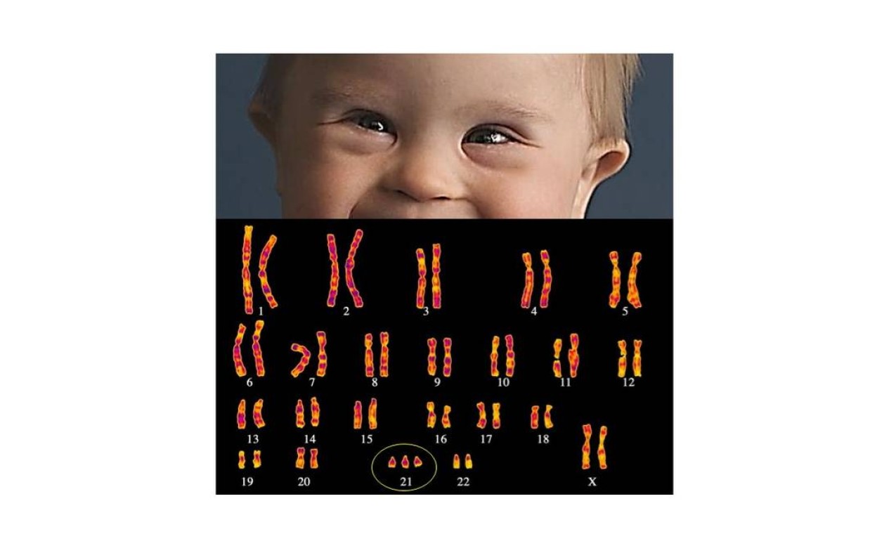 A Sindrome De Down É Um Exemplo De Alteração
