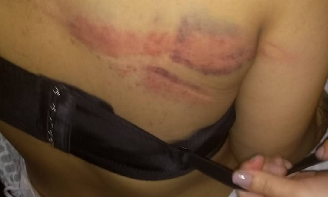 Adolescente de 17 anos foi agredida durante tumulto em baile funk; ela levou cerca de 50 pontos pelo corpo Foto: Reprodução