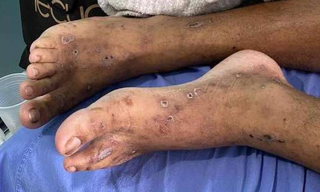 Presos estão internados com doença de pele infecciosa Foto: Divulgação/OAB-RR