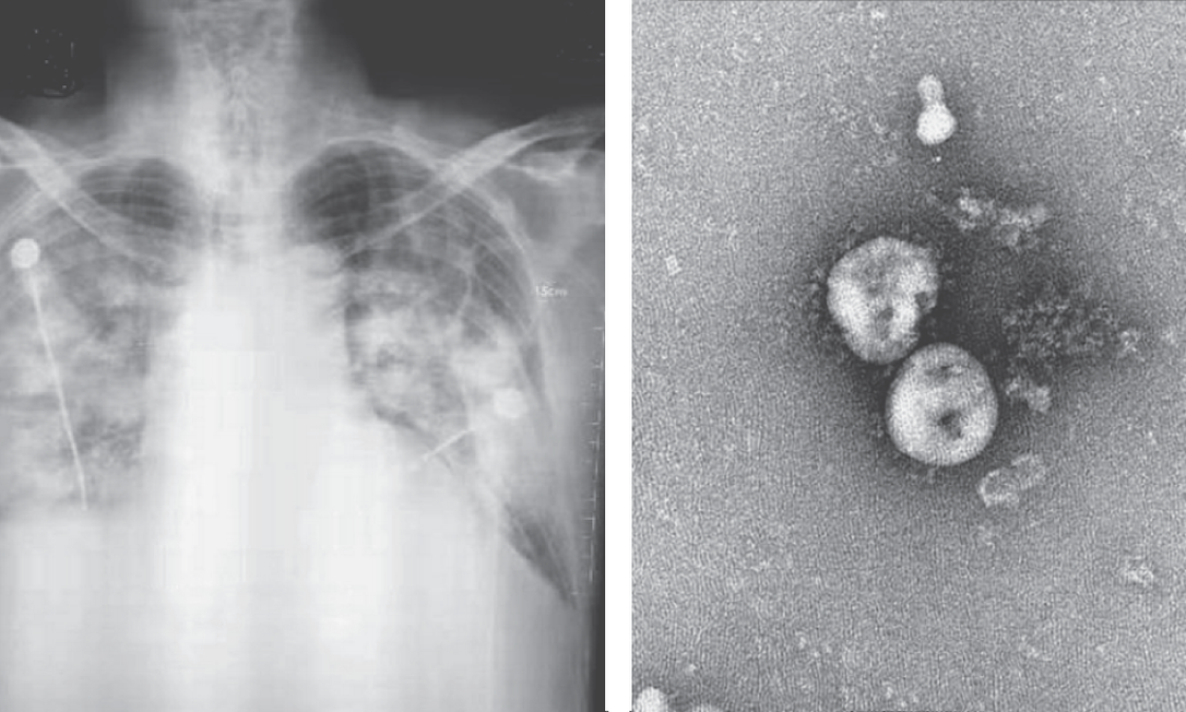 Radiografia de pulmão de paciente do novo coronavírus na China e imagem de microscópio do patógeno Foto: Rperodução / NEJM
