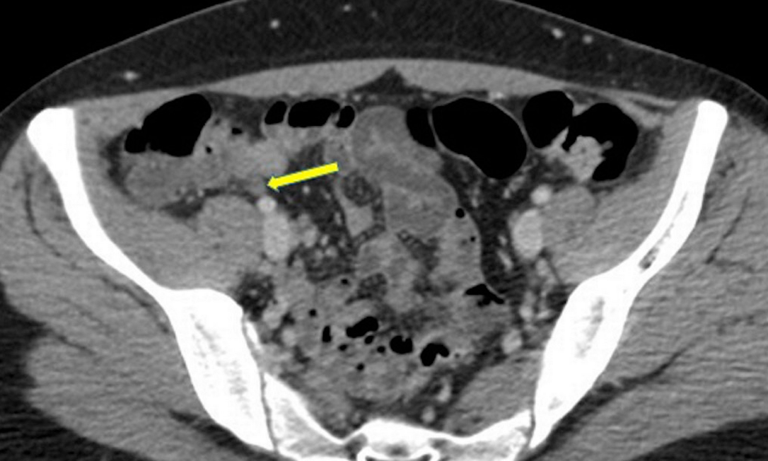 Imagem de tomografia computadorizada indica localização de apendicite em paciente de sarampo em Malta Foto: Xerri et al. / BMJ