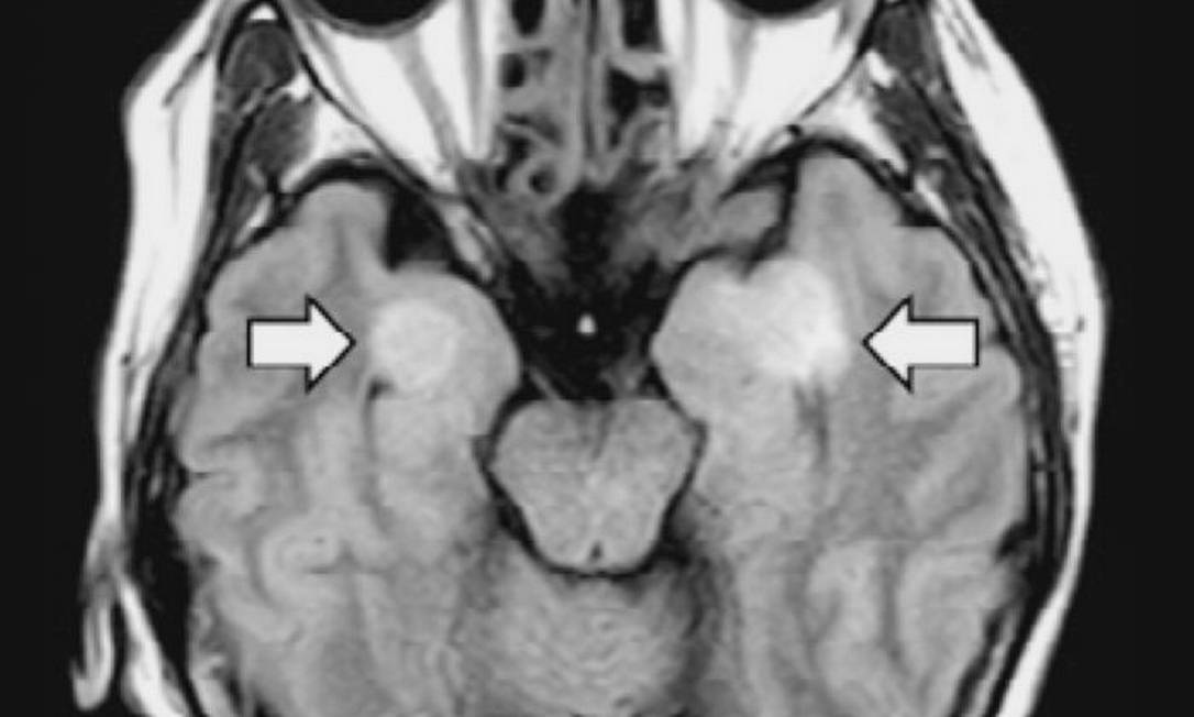 Cérebro de paciente da Covid-19 de 58 anos indica quadro de encefalite, possivelmente decorrente do coronavírus Foto: Sociedade de Radiologia da América do Norte