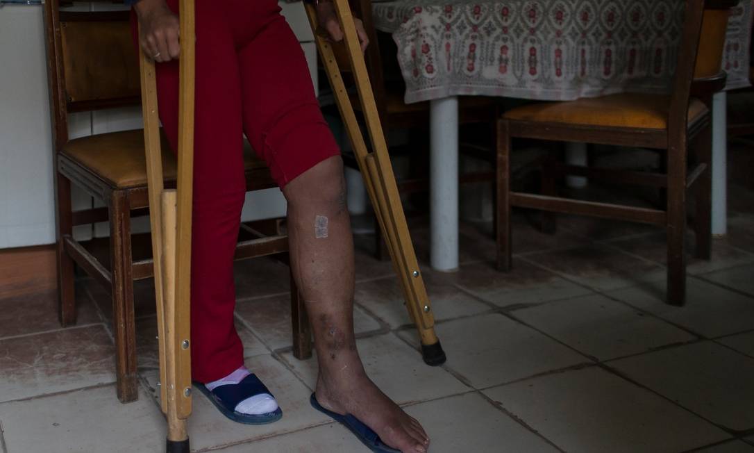 A mulher fez cirurgia e ainda se recupera das lesões na perna quebrada na ação Foto: Edilson Dantas/Agência O Globo