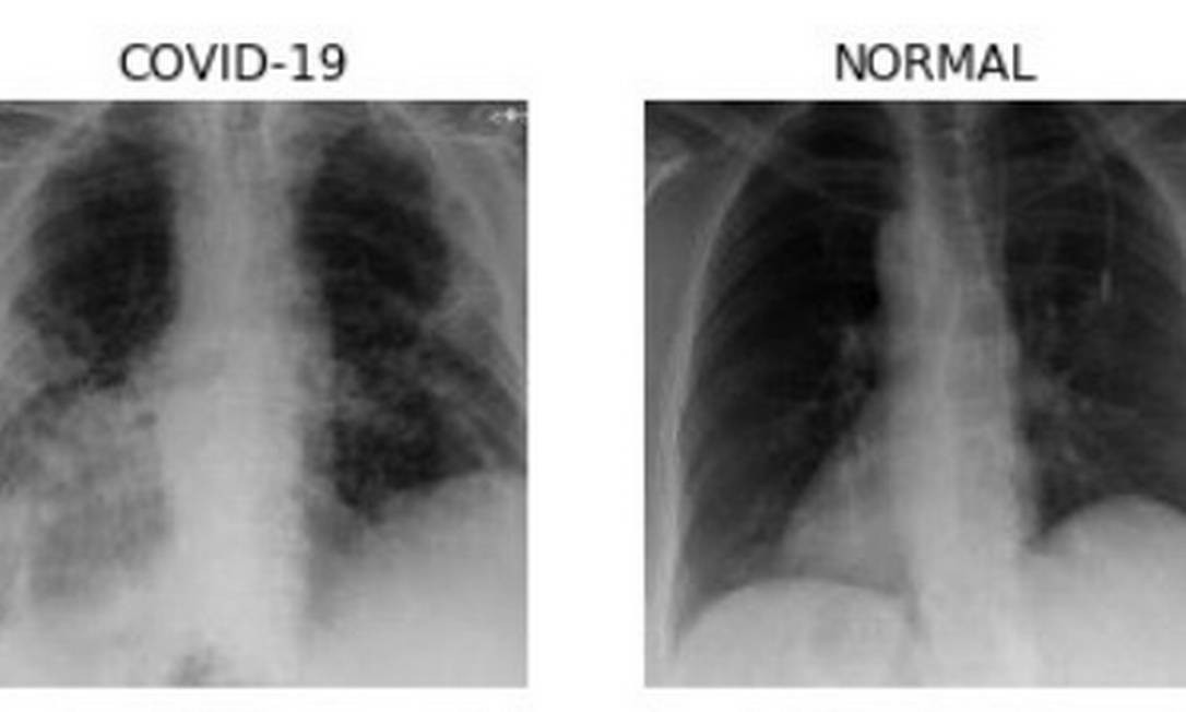 Imagens de raio-x mostram um pulmão saudável e outro infectado pelo novo coronavírus Foto: Reprodução
