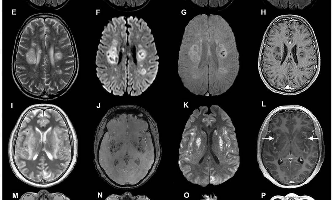 Imagens cerebrais de pacientes com coronavírus, de um estudo publicado em julho. Alguns desenvolvem complicações neurológicas graves, incluindo danos nos nervos. Foto: Ross W. Paterson, Rachel L. Brown, et al. / Imprensa da Universidade de Oxford / via NYT