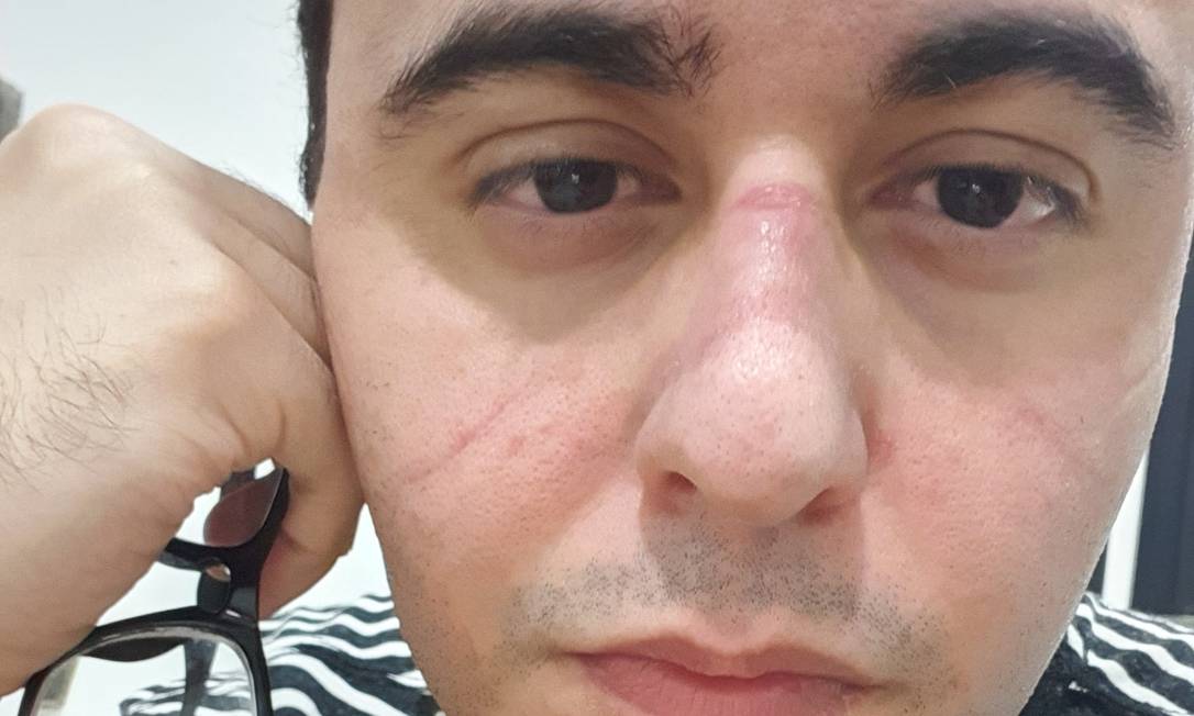 Médico João Pedro Rodrigues Feitosa mostrou a marca da máscara no rosto após um plantão. Foto: Reprodução/Redes sociais