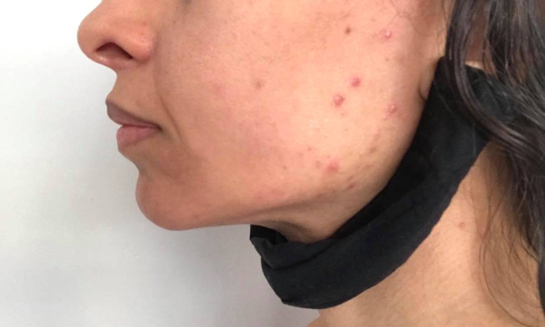 Segundo especialista, a máscara abafa o local e aumenta a oleosidade, que gera acne Foto: Foto do leitor / Kelly Morgana