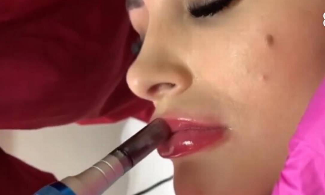Andressa Urach faz procedimento estético nos lábios Foto: Reprodução
