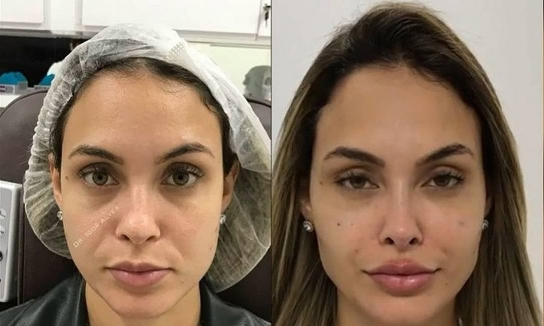 Confira o antes e depois de famosos que fizeram harmonização facial