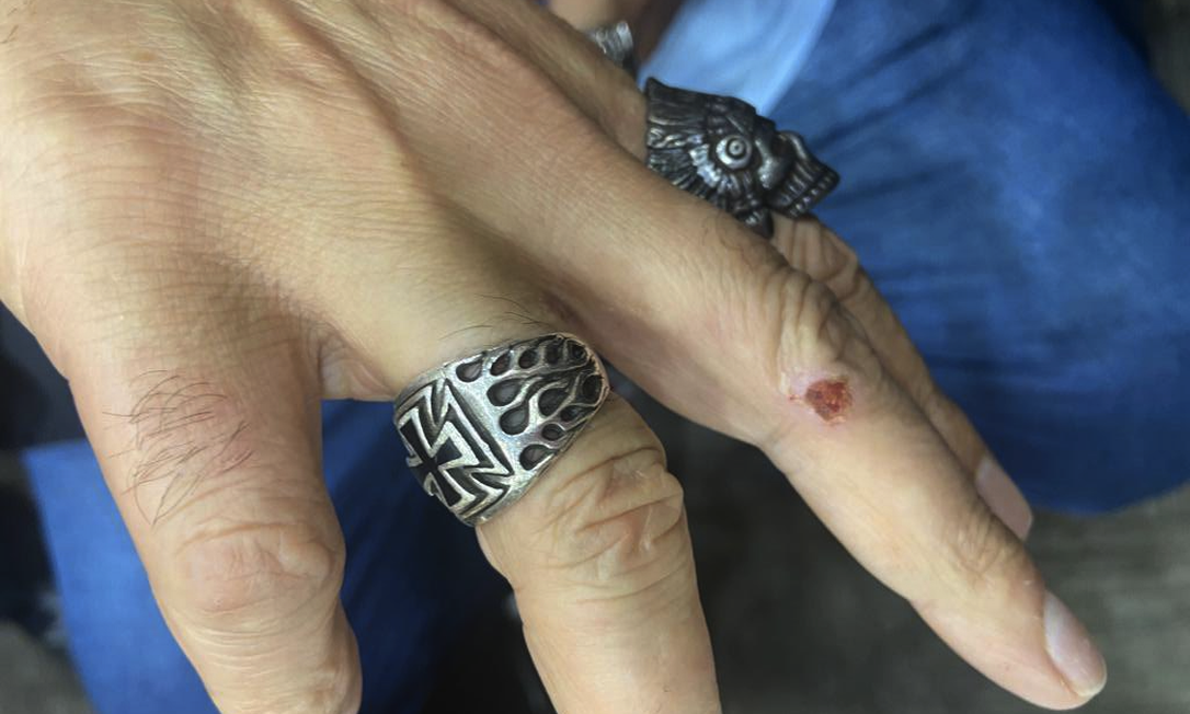 Dedo de Claudio Janta após mordida de manifestante Foto: Kelly Matos - GZH / Reprodução