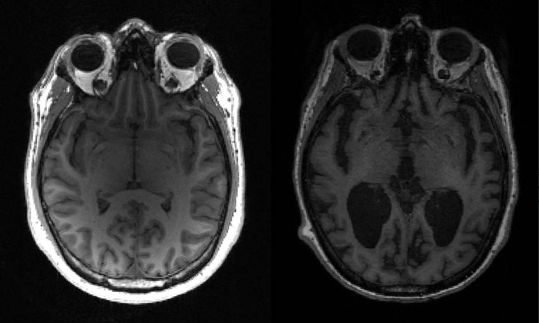 Imagem mostra cérebro saudável, à esquerda, e outro com alzheimer, à direita, com grandes áreas escuras Foto: TIMOTHY RITTMAN / AFP