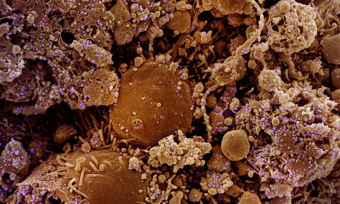 Micrografia eletrônica de varredura colorida de células cronicamente infectadas e parcialmente lisadas (marrom) infectadas com uma cepa variante de partículas do coronavírus (roxo), isoladas de uma amostra de paciente. Foto: NIH/NIAID