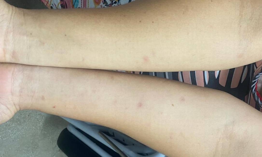 Lesões de pele que causam coceira se espalharam por Pernambuco. Foto: SBD/Divulgação
