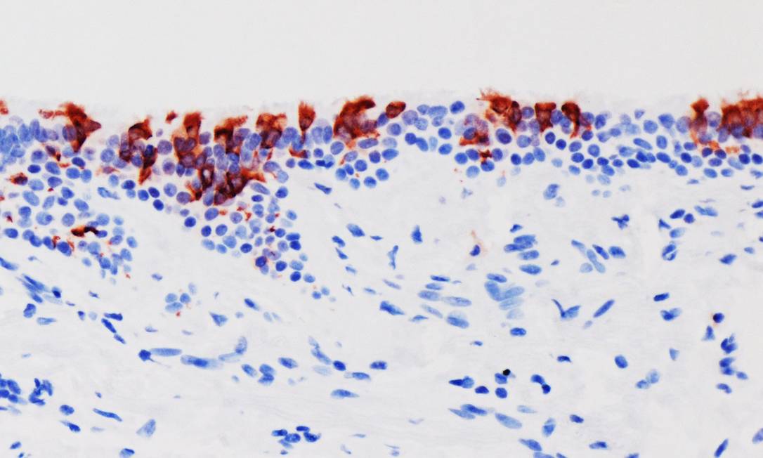 Variante Ômicron (em vermelho) nos tecidos de brônquios humanos infectados. Foto: Universidade de Hong Kong/Divulgação