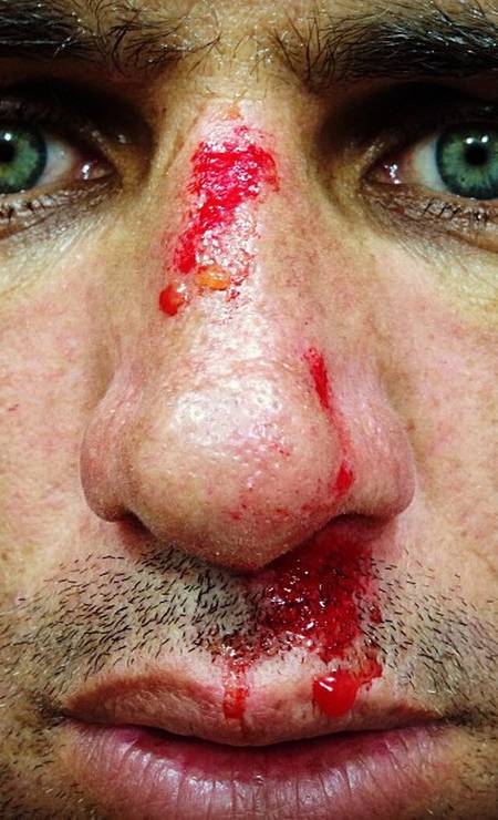 Kelly Slater com rosto machucado ao pegar "jacaré" e bater em banco de areia em praia do Rio Foto: Reprodução / Instagram