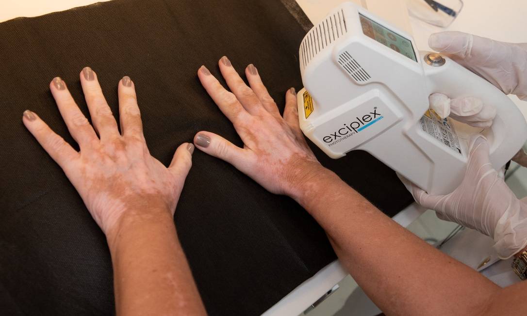 
Procedimento. O Excimer é uma nova tecnologia para tratamento do vitiligo
Foto: Divulgação