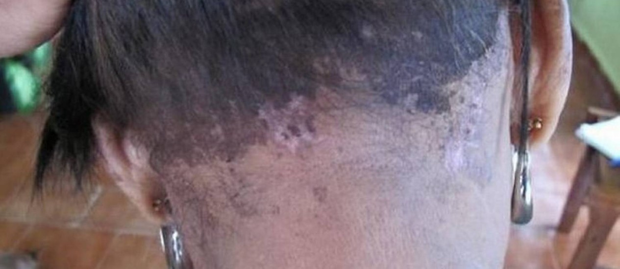 Mulher tem couro cabeludo queimado ao fazer escova progressiva em Santa