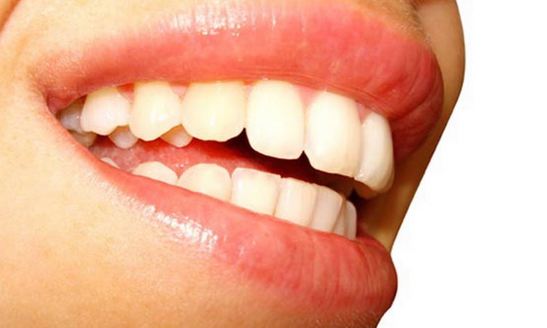 
Dentes bonitos ajudam o organismo a se manter saudável, mas é preciso tomar cuidado com o excesso de exames de raios X, aponta estudo americano
Foto: Reprodução