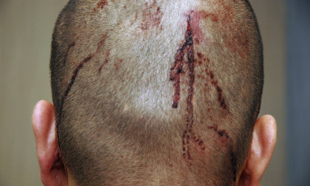 
Foto divulgada por procuradores americanos mostram ferimento na parte de trás da cabeça de George Zimmerman
Foto: AP