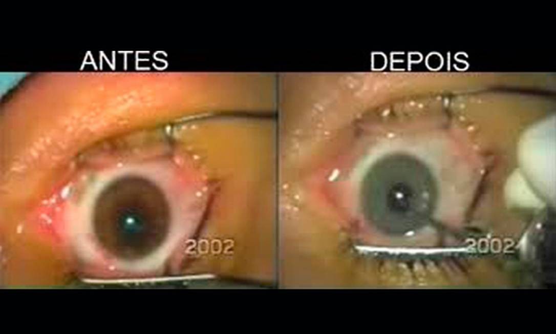 Cirurgia Recomendada Por Médico Deixou Dois Pacientes Cegos Jornal O Globo 8209