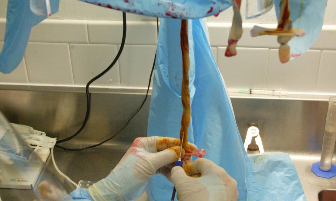 
Cordão umbilical sendo extraído da placenta: corte um minuto após o nascimento permite passagem de sangue maior e beneficia o bebê
Foto: Ruby Washington / NYT