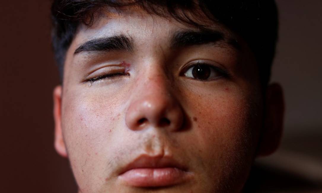 Miguel Veloso, de 16 anos, atingido no olho por uma bala de borracha durante um protesto em Santiago: especialistas dizem que projéteis devem ser mirados para o chão Foto: JORGE SILVA / REUTERS