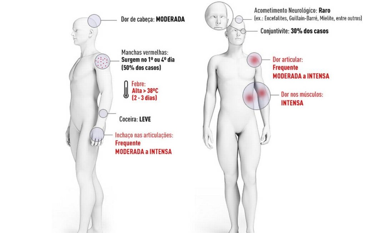 Conheça os sintomas da Chikungunya Foto: Reprodução: Ministério da Saúde