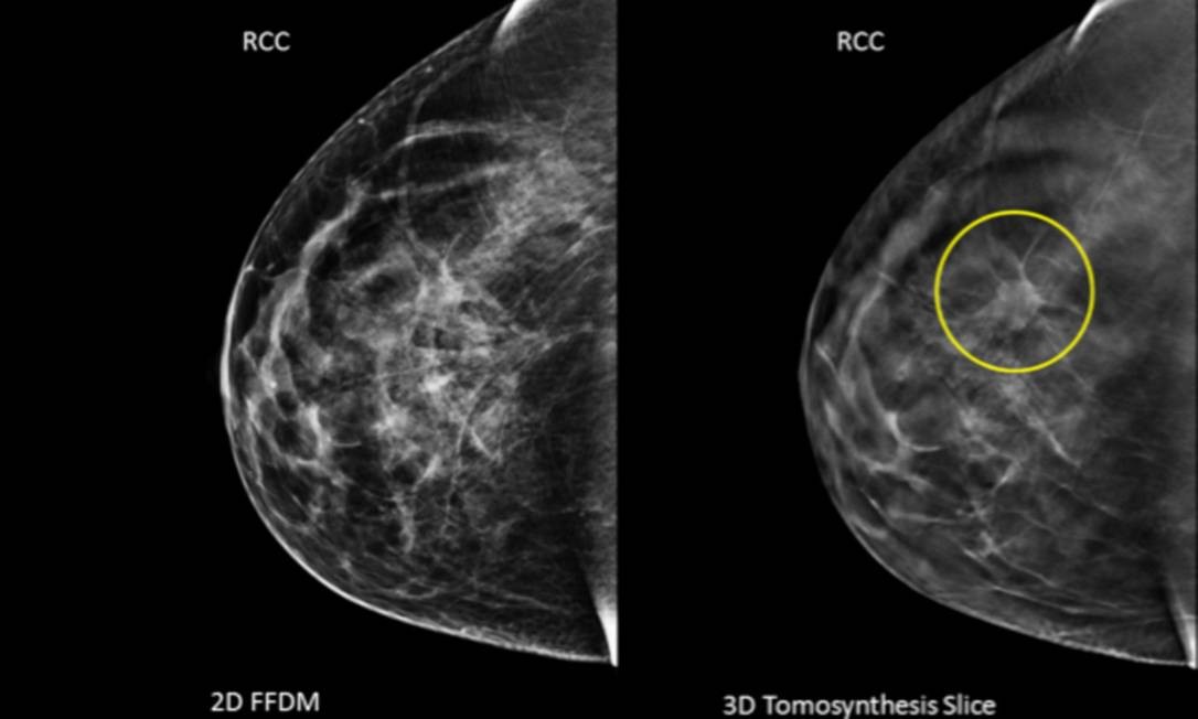 Resultado de imagem para mamografia